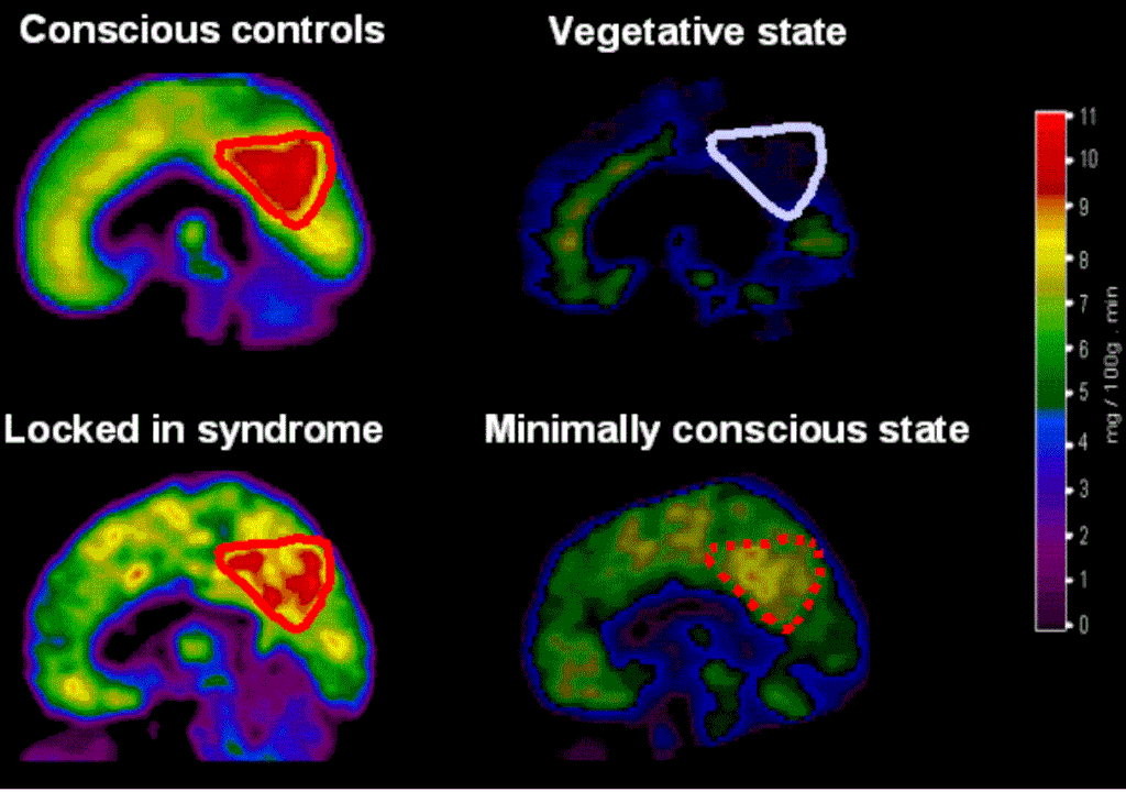 Brain scans of various disorders of consciousness